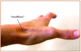 Image result for Scaphoid Fracture Signs