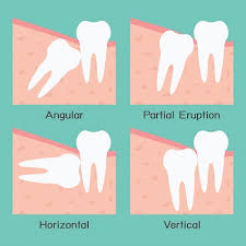 How long does wisdom teeth surgery take? Cost To Remove Wisdom Teeth Nz Teethwalls