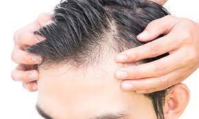 Temporary hair loss can be a sign of a medical issue, like anemia or thyroid problems. Male Pattern Baldness Causes And Treatment