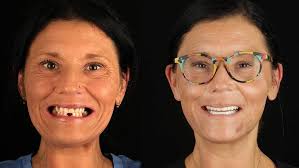 All-on-4 Dental Implants Chattanooga — Hixson Dental Group