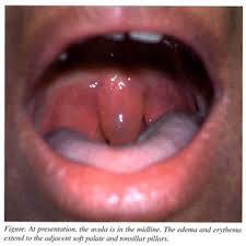 Image result for Uvulitis