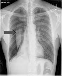 Image result for Pneumothorax