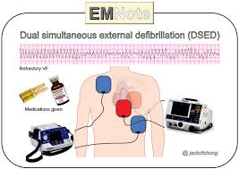 Image result for Defibrillation