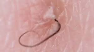 Common areas for ingrown hairs. The Tweezist Ingrown Hair Tweezing Instagram Is Going To Be Your New Obsession Metro News