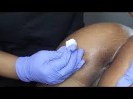 브라질리언 레이저 제모는 보통 4~6주 간격으로 5~6회 시행된다. ì—¬ìž ë¸Œë¼ì§ˆë¦¬ì–¸ ì™ì‹± 2ë°°ì† ëŒ€ìŒìˆœ ì•µê¸€ í¬ì»¤ìŠ¤ How To Women Brazilian Waxing Youtube