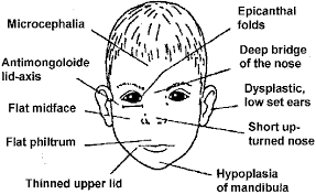 Epicanthal folds are oblique or vertical folds from the upper or lower eyelids towards the medial canthus. John Libbey Eurotext European Journal Of Dermatology Fetal Alcohol Syndrome Fas In Dermatology An Overview And An Evaluation