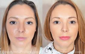 Maybe you would like to learn more about one of these? Rhinoplasty Before After Photos At Beverly Hills Profiles