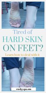 There are many skin conditions that cause red spots on skin. How To Get Rid Of Dead Skin On Feet Step By Step Guide Cushy Spa