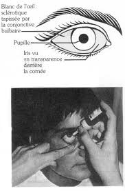 Entre 3 à jours après une griffure ou une morsure, le patient qui a une maladie des griffes du chat présente. Developpement Et Sante Conduite A Tenir Devant Un Oeil Rouge Pour L Infirmier Non Ophtalmologiste