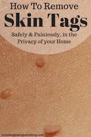 How To Remove Skin Tags At Home Updated Skin Tag Removal Skin Tags Home Remedies Skin Tag On Eyelid