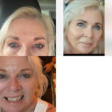 Hi , I had this done in February, just the top lid but the under eye seems  to have improved too ! Best decision I've made . Been using castor oil on