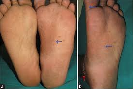 Image result for pompholyx soles of feet