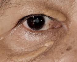 Image result for xantelasma