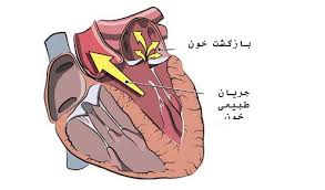 Image result for ‫بزرگ شدن دهلیز چپ‬‎