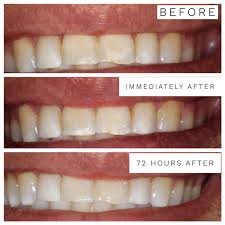 Whitening toothpastes have fluoride, which strengthens enamel, as well as chemicals or polishing agents that specialize in removing stains. Sunshine Smiles Of Orange County Blog How To Get Rid Of White Spots On Your Front Teeth Easily And Pain Free