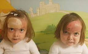 Las Gemelas Con Piel De Mariposa Carla Y Noa Envian Un Video Mensaje De Animo Para Superar La Cuarentena Por Coronavirus El Correo