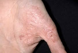 If you suspect that you have some form of eczema, see a take the full round of antibiotics that your doctor prescribes. Eczema Pictures What An Eczema Rash Looks Like