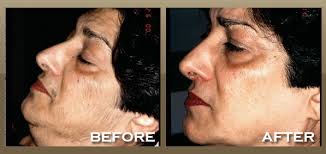 Avoid plucking, waxing, or bleaching your hair for 6 weeks prior to your appointment as plucking out hair by the root will decrease the effectiveness of your laser treatment. Facial Hair Laser Removal Before And After