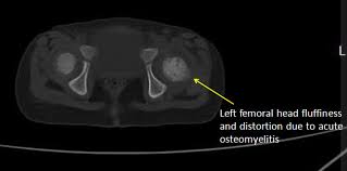 Image result for Osteomyelitis Bone Scan