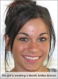 6 month smiles clear adult braces available at Time Dental near Farnborough, Hampshire