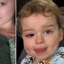 Scots toddler left blind after bumping head while learning to walk