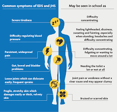 Image result for Hypermobility Signs