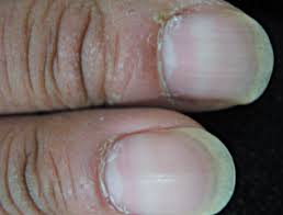 Image result for Muehrcke Line