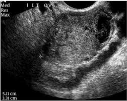 Check spelling or type a new query. A 22 Year Old Gravida 1 Para 0 Woman With A Left Hemorrhagic Ovarian Download Scientific Diagram