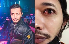 Karl Shafek sakit lagi, mata kiri bernanah... nampak macam ada semut  merayap