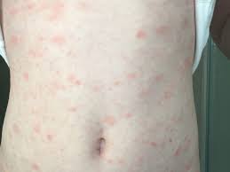 It is common in hot, humid weather and affects not only the children but also adults. Rashes Can Be A Better Sign Of Having Covid 19 Than Fever Or Cough Study Claims Mirror Online