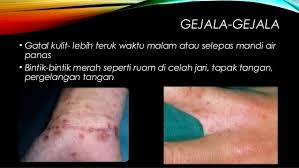 In recent decades, its popularity has grown in other areas of the world as an alternative and complementary treatment. Cara Mengatasi Penyakit Kudis Buta Scabies Semudah Abc Nutrisi Guru