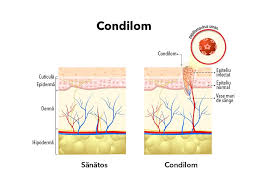 Mancărimi in zona intimă cauze simptome și tratament. Negii Genitali Condilomatoza Genitala Simptome Diagnostic È™i Tratament Behealthy