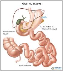 Surgical Program Obn