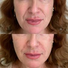 Pyriform, Nasolabial fold & cheek filler 🤎💉 Goal: Softening the deep set  lines within the pyriform fossa/nasolabial folds, while providing a lift  within the cheeks to balance the face. We coupled this