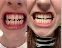 Ask Your Fort Worth Dentist: Should I Get Metal Or Clear Braces? Archstone  Dental & Orthodontics, Tx