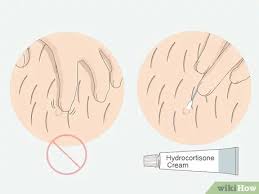 Make sure the skin is soft before removing the hair. How To Get Rid Of Ingrown Pubic Hair With Pictures Wikihow