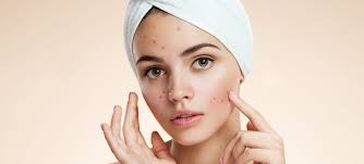 Caranya cukup mudah, oleskan es batu pada area wajah yang. Es Batu Bisa Mengatasi Jerawat Doktersehat