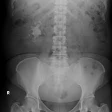 Large stones are in the ureter 4. Staghorn Calculus Radiology Case Radiopaedia Org