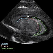 Caudothalamic Groove Radiology Reference Article Radiopaedia Org Diagnostic Imaging Diagnostic Medical Sonography Ultrasound Technician