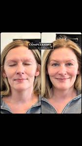 🖊️Advanced Scar Revision Therapy ☑️Done with precision, intention, &  expertise. ✈️ Traveling in? Ask us about concierge scheduling & hotel recs!  ✨This is true skin healing, from the inside out. At COMPLEXIONS