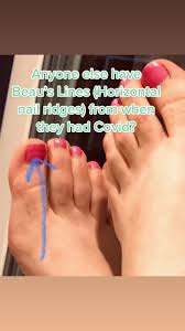 Image result for Beau lines feet