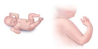 The feet usually correct themselves by 3 months. Facts About Upper And Lower Limb Reduction Defects Cdc