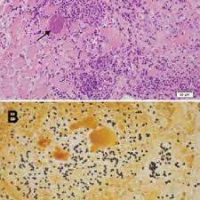 Exquisite pain and swelling of affected muscle with induration. Pdf Anncaliia Algerae Microsporidial Myositis