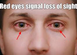 We did not find results for: Health Why Are My Eyes Red And Itchy How To Treat Red Eyes Red Eyes Signal Loss Of Sight How To Get Rid Of Red Veins In Eyes