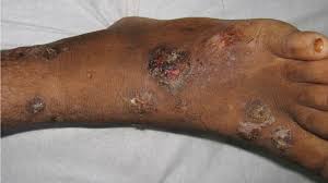 Image result for Impetigo