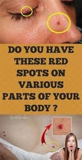 Do You Have These Red Spots On Various Parts Of Your Body Should You Worry What Should You Do Skin Spots Body Health Skin Problems