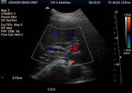 Maybe you would like to learn more about one of these? Abdominal Ultrasound Cedars Sinai