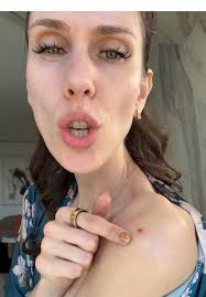 Skincare Tips from an Esthetician: Treat Your Pimples