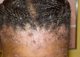 Anyone with serious skin issues can experience hair loss i have been on dupixent for 3 years and i was having issues with hair loss. It S More Than Just Dandruff Mdhairmixtress Com