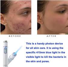 Acne Laser Pen Wrinkle Removal Machine Durable Scar Remover Blue Light Therapy Pen Massage Spider Vein Eraser Facial Care Tools Home Use Beauty Devices Aliexpress